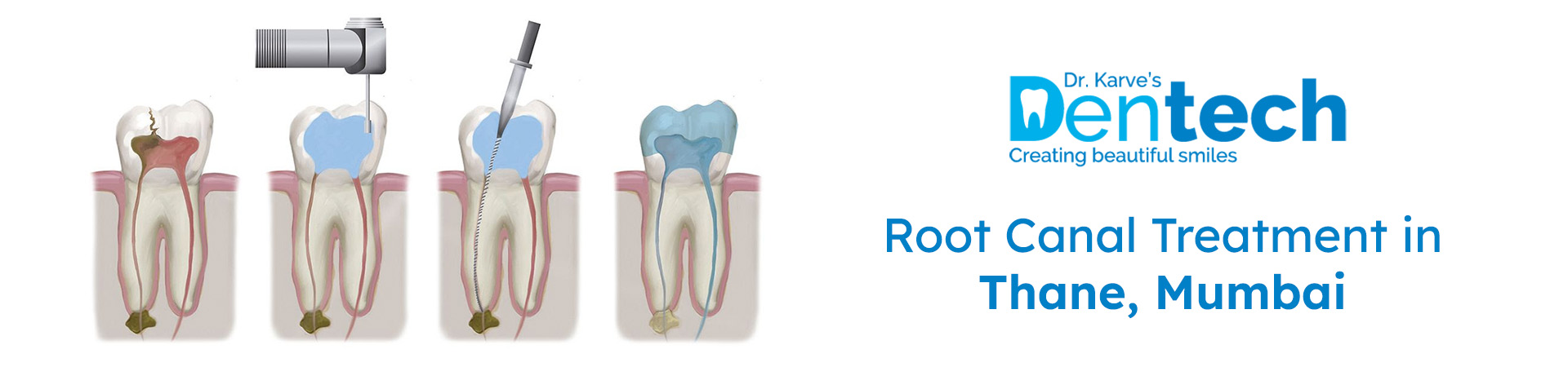 root canal treatment in thane, mumbai.