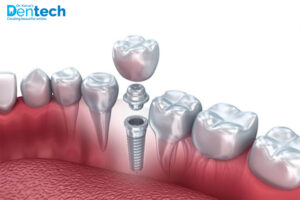 Dental Implant Cost in Powai, Mumbai