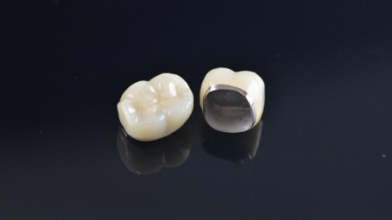 Porcelain Fused to Metal (PFM) Crowns