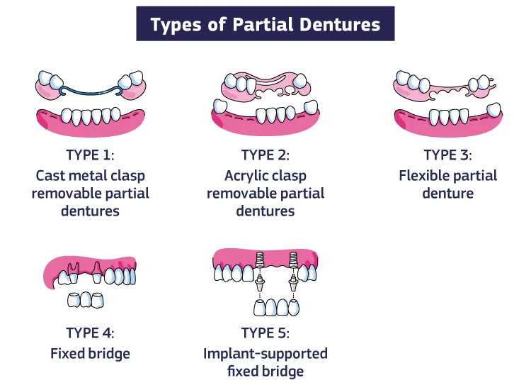 Partial Dentures: Cost, Treatment & Types in India