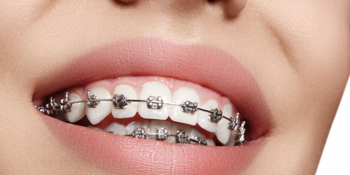 Orthodontics treatment in Powai