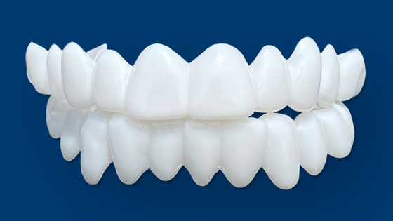 Removable Veneers