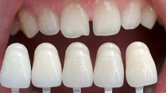 Composite Veneers