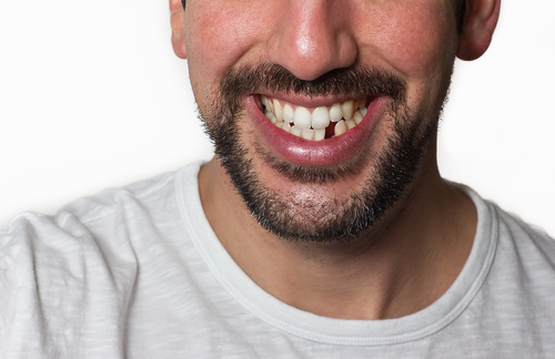 Missing Teeth Ill-Effects and Solutions - Dr. Karve's Dentech