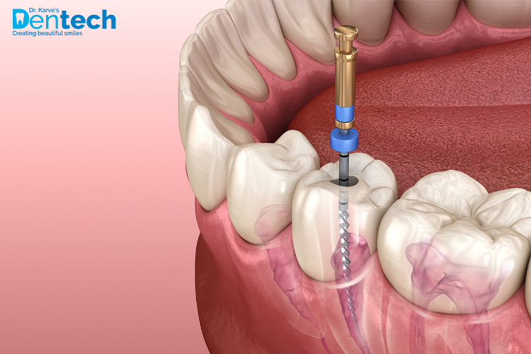 Root Canal Treatment Complete Guide - Dr. Karve's Dentech