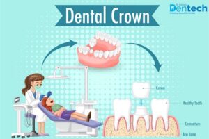 Dental Implant Cost in Powai, Mumbai