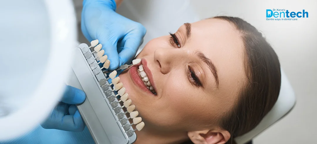 Dental Veneers in Thane at Dr. Karve's Dentech