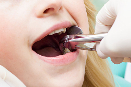 wisdom tooth extraction | Painless tooth extraction 
