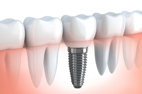 Dental implant & tooth implant in Powai and thane