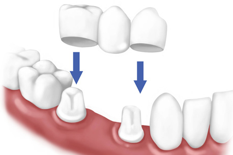  Dental Crowns & Bridges | Natural teeth