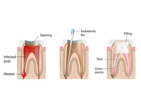 Best Root canal Treatment in Thane