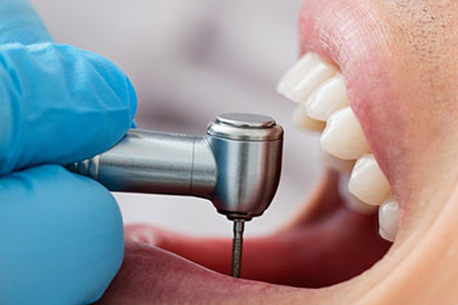 Dental restorative treatment in Powai and Thane