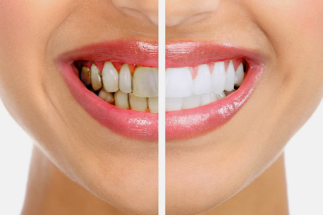 Best Teeth Whitening dental clinic near thane & powai | Dentech