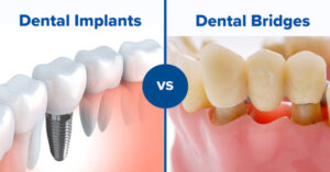 Which is better: Crown Bridges or Tooth implants?