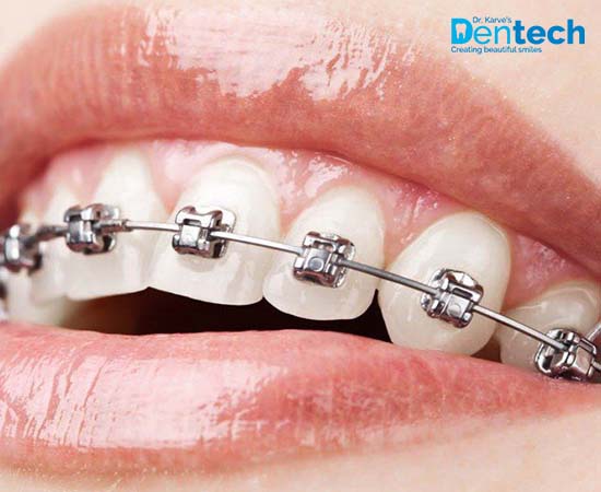 Dental Braces Treatment Cost in Powai