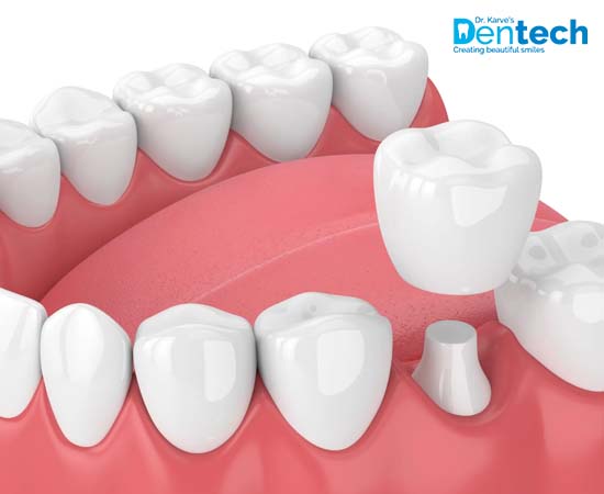 Dental Crown Treatment Powai