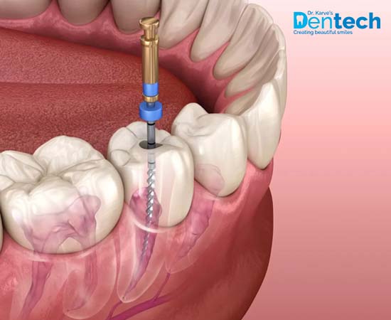Root Canal Treatment in Powai