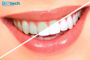 Confused Between Teeth Cleaning and Teeth Whitening?