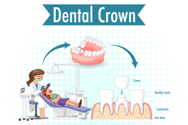 Dental Crown Cost in India