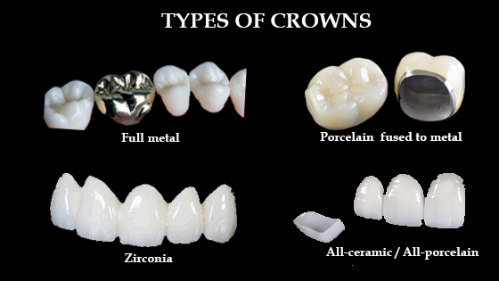 types of dental crown - Dentech