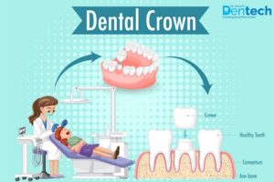 Dental Crown Cost in Mumbai, India – Dentech