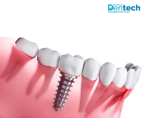 Dental Implant Treatment in Powai