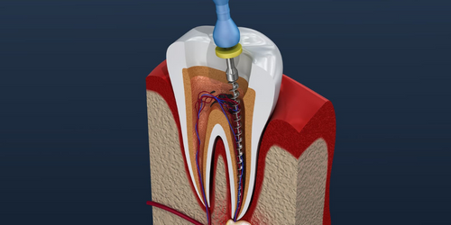 Root Canal Treatment in Powai