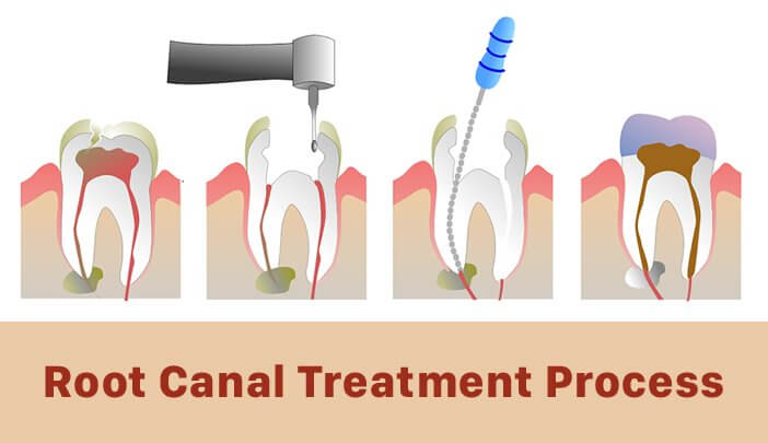 Root Root Canal Treatment Process