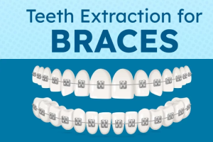 Teeth Extraction for Braces: Alternatives and More