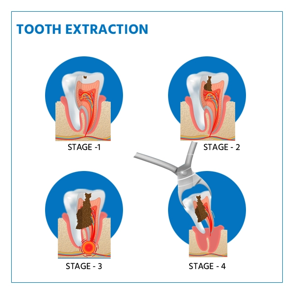 Tooth Extractions For Braces