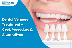 Dental Veneers Treatment – Cost, Procedure & Alternatives