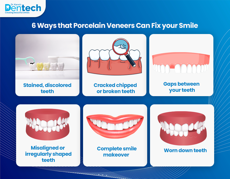Reasons to Have Dental Veneers Cost