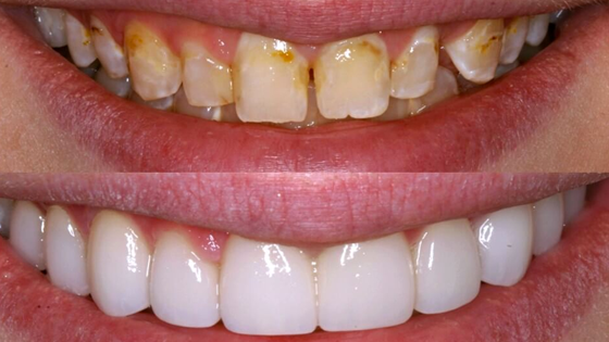 Dental Veneers: Before and After