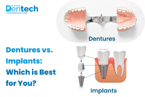 Dentures vs. Implants: Which is Best for You?