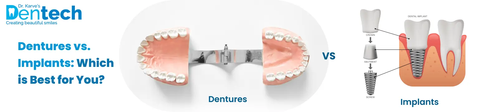 Dentures vs. Implants: Which is Best for You?